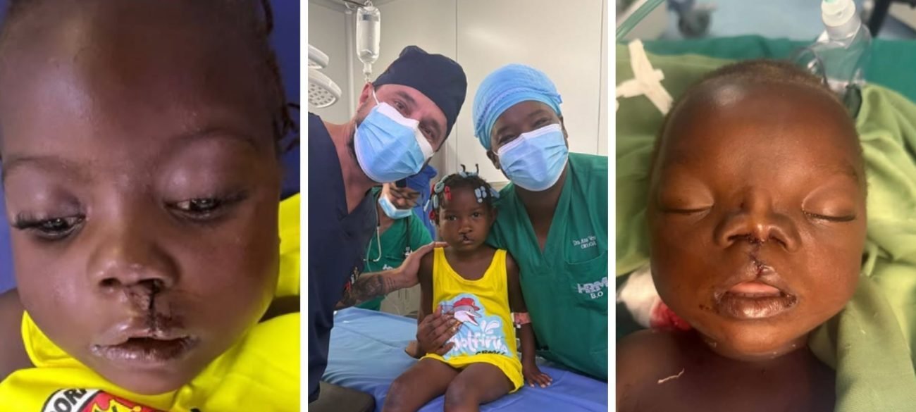 Dentista de SC devolve capacidade de mamar a bebê angolano e lidera série de 80 cirurgias reconstrutivas em missão humanitária - Imagem do artigo original